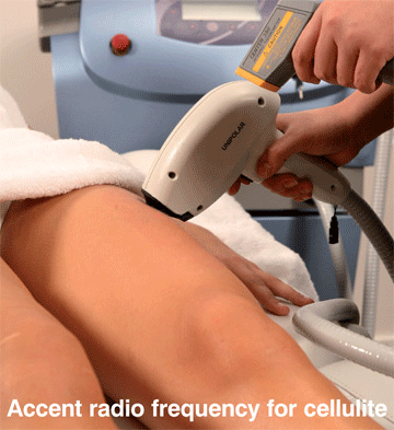 Get rid of Cellulite using Accent RF or reducing fat  with non sugrgical liposuction