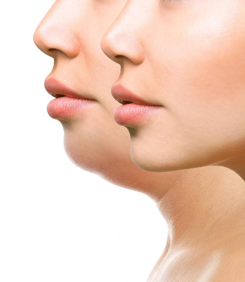 Aesthetica Double Chin Treatment Injectables