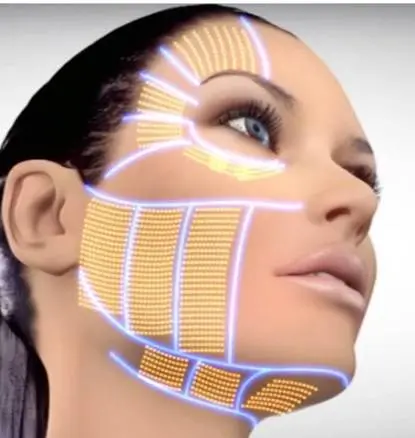 dDagram of Ultherapy treatment areas Melbourne