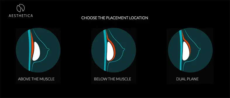 Aesthetica placement of implants Aesthetica breast augmentation , placement of breast implants