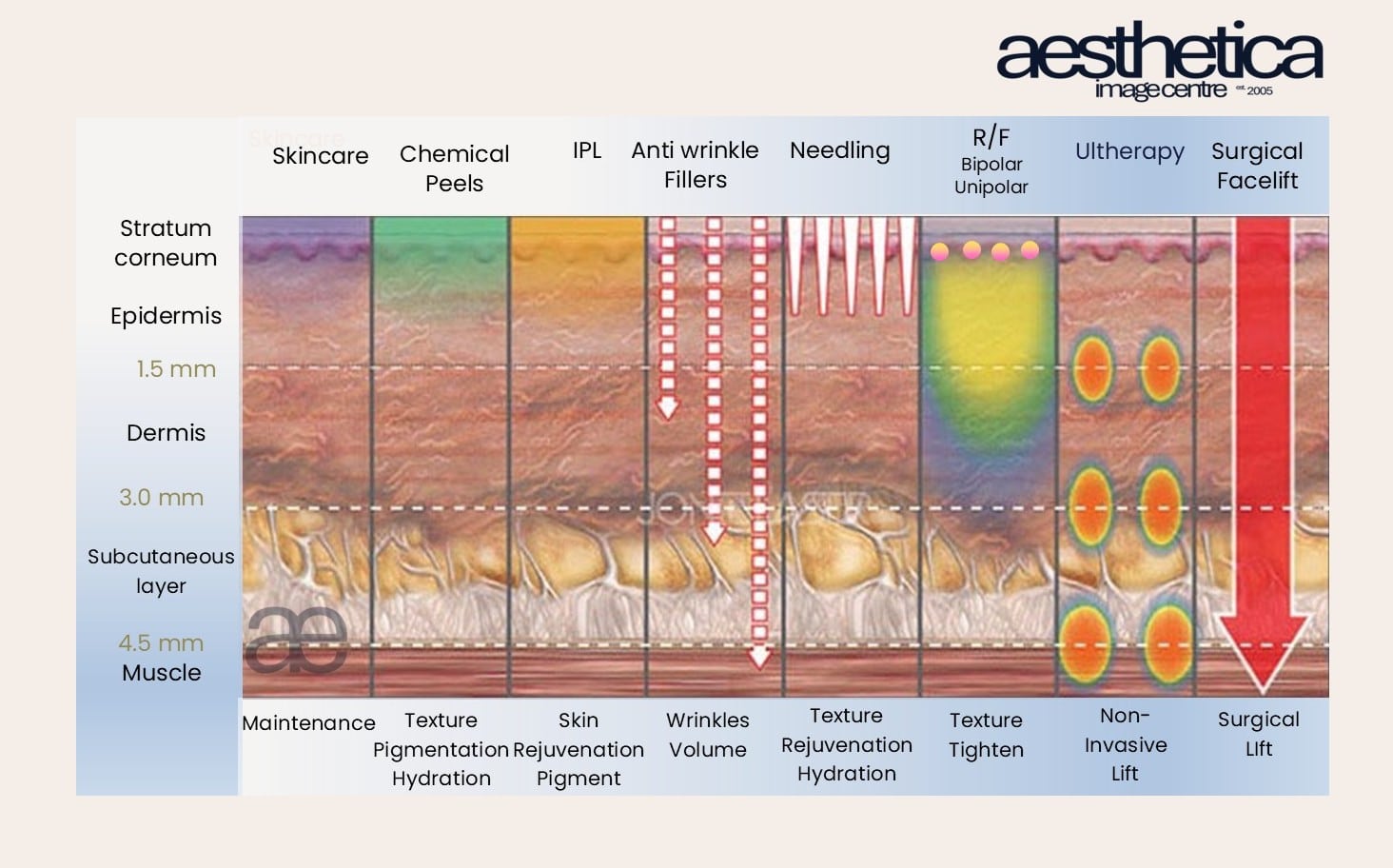 Aesthetetica Infographic on depths of Ultherapy and non-surgical treatments