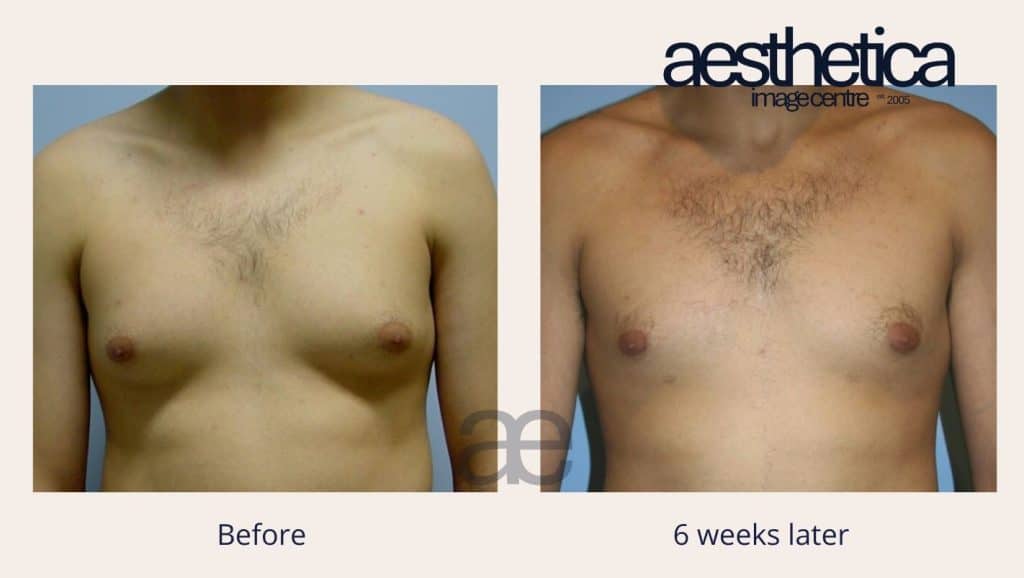 Aesthetica image Centre Gynecomastia result