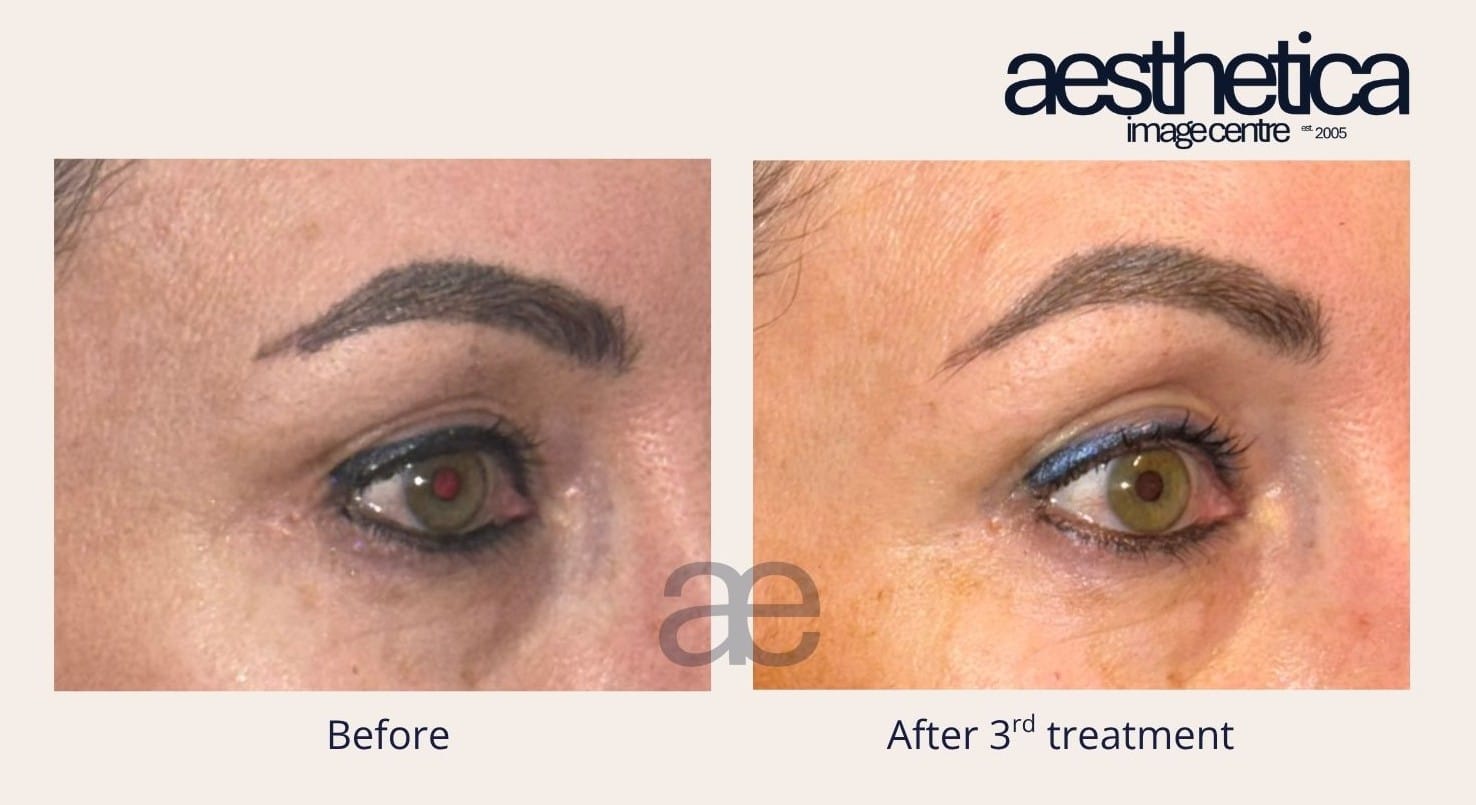 Aesthetica Image Centre Before and after picture non-surgical eye lift using Viora