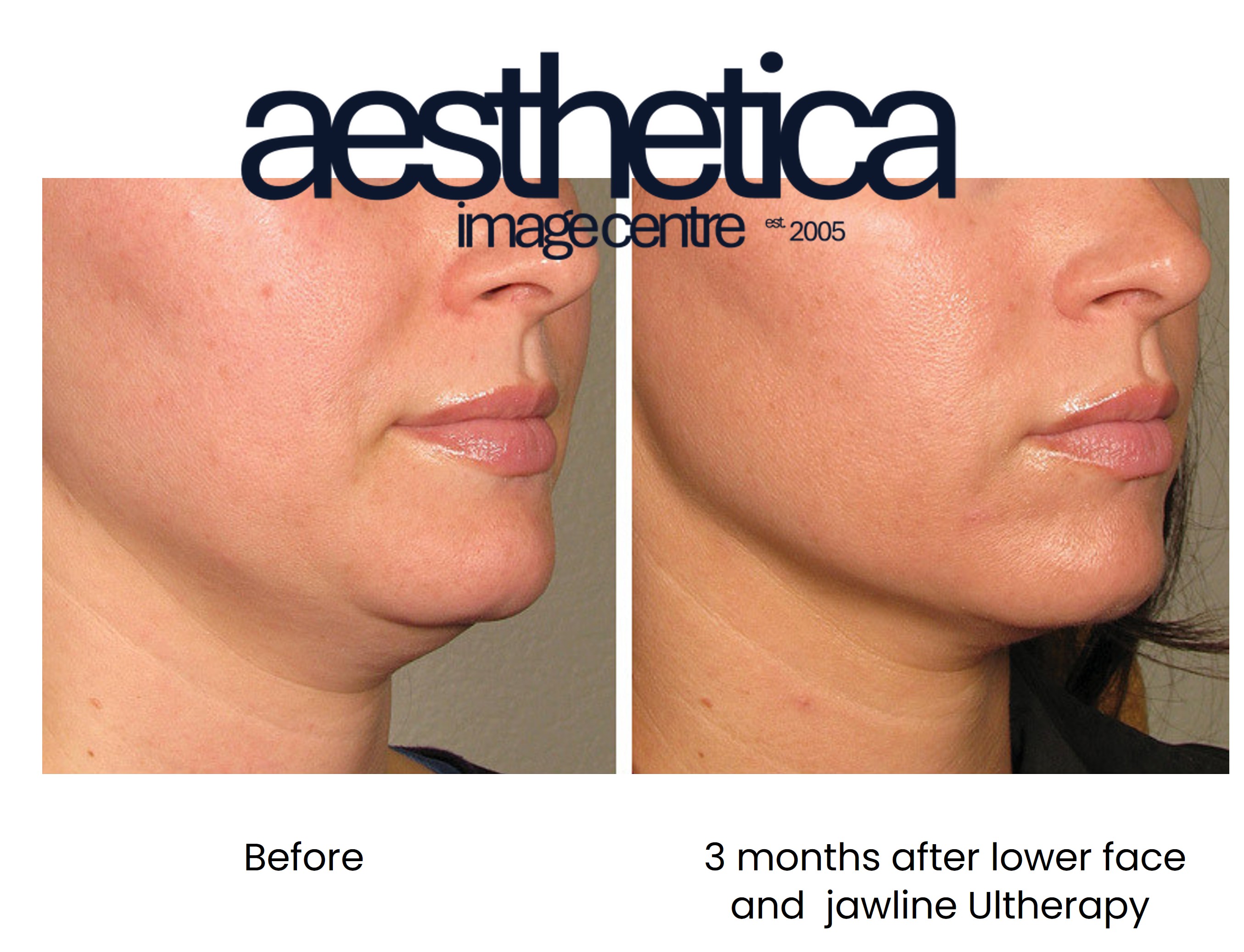 Before and after Ultherapy treatment at Aesthetica Image Centre, showing improved jawline and skin tightening