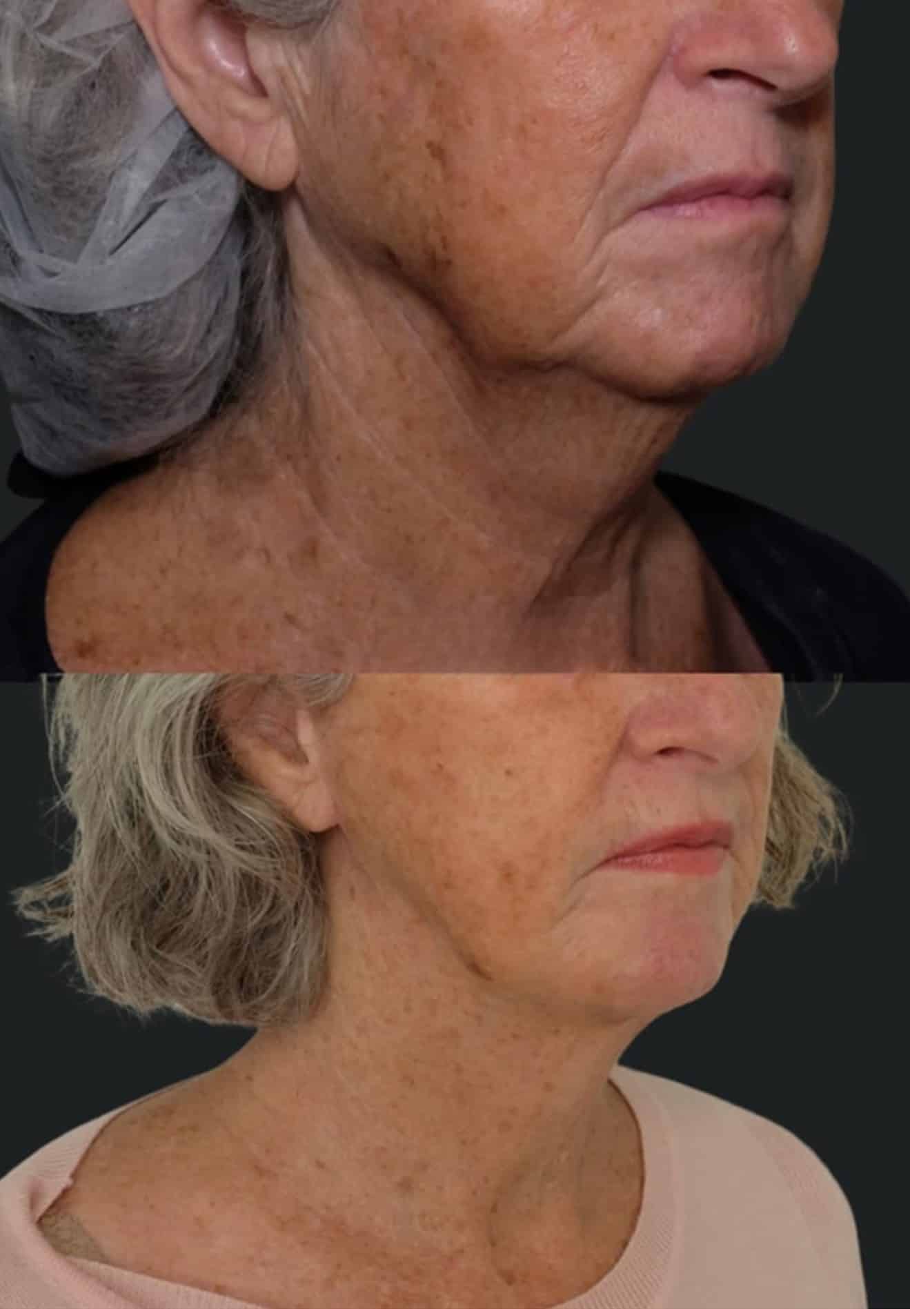 Mini facelift (SMAS lift) before and after example at Aesthetica Image Centre, Armadale Melbourne