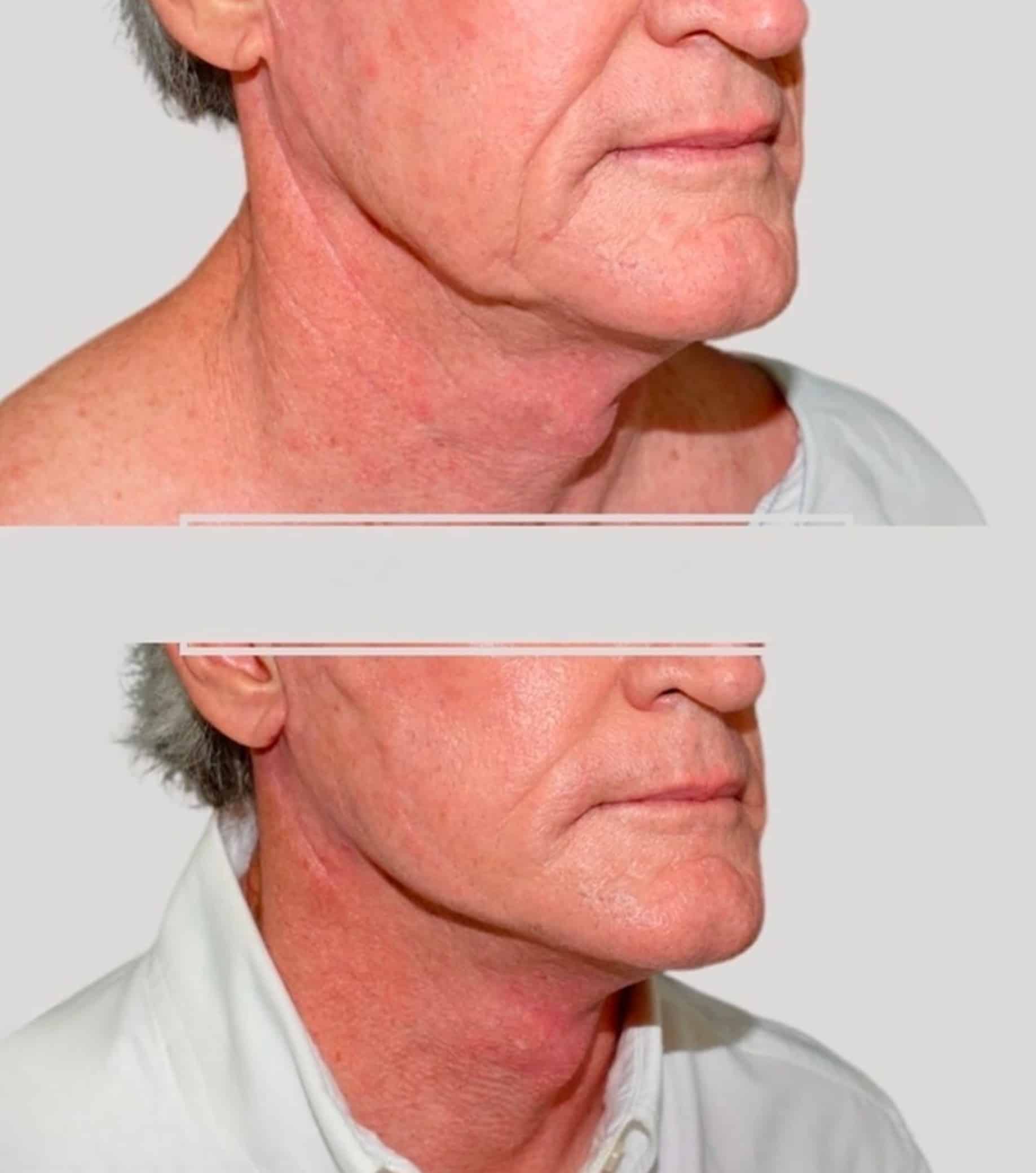 Male mini facelift (SMAS) before and after example at Aesthetica Image Centre, Armadale Melbourne