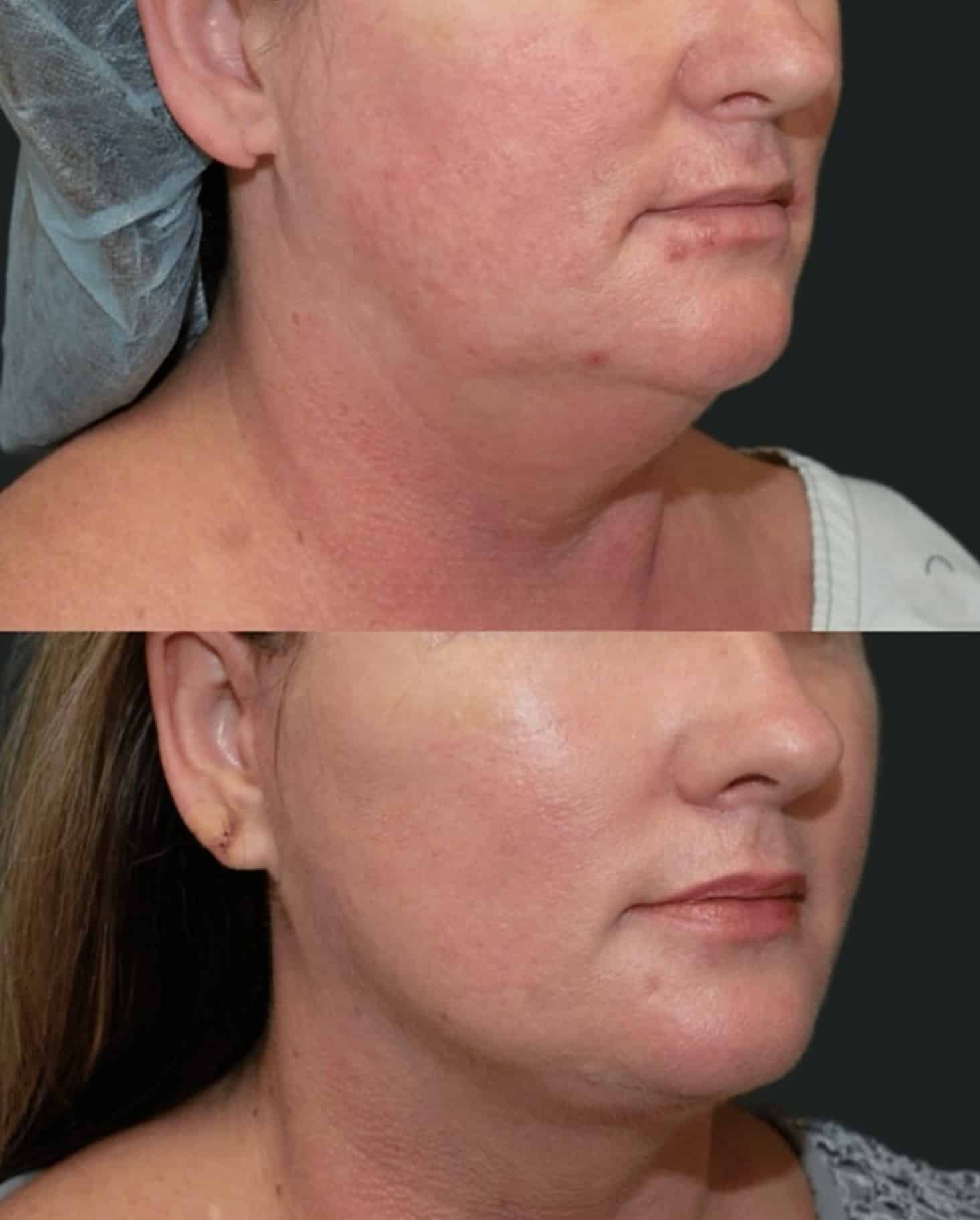 Mini facelift (SMAS) before and after example at Aesthetica Image Centre, Armadale Melbourne