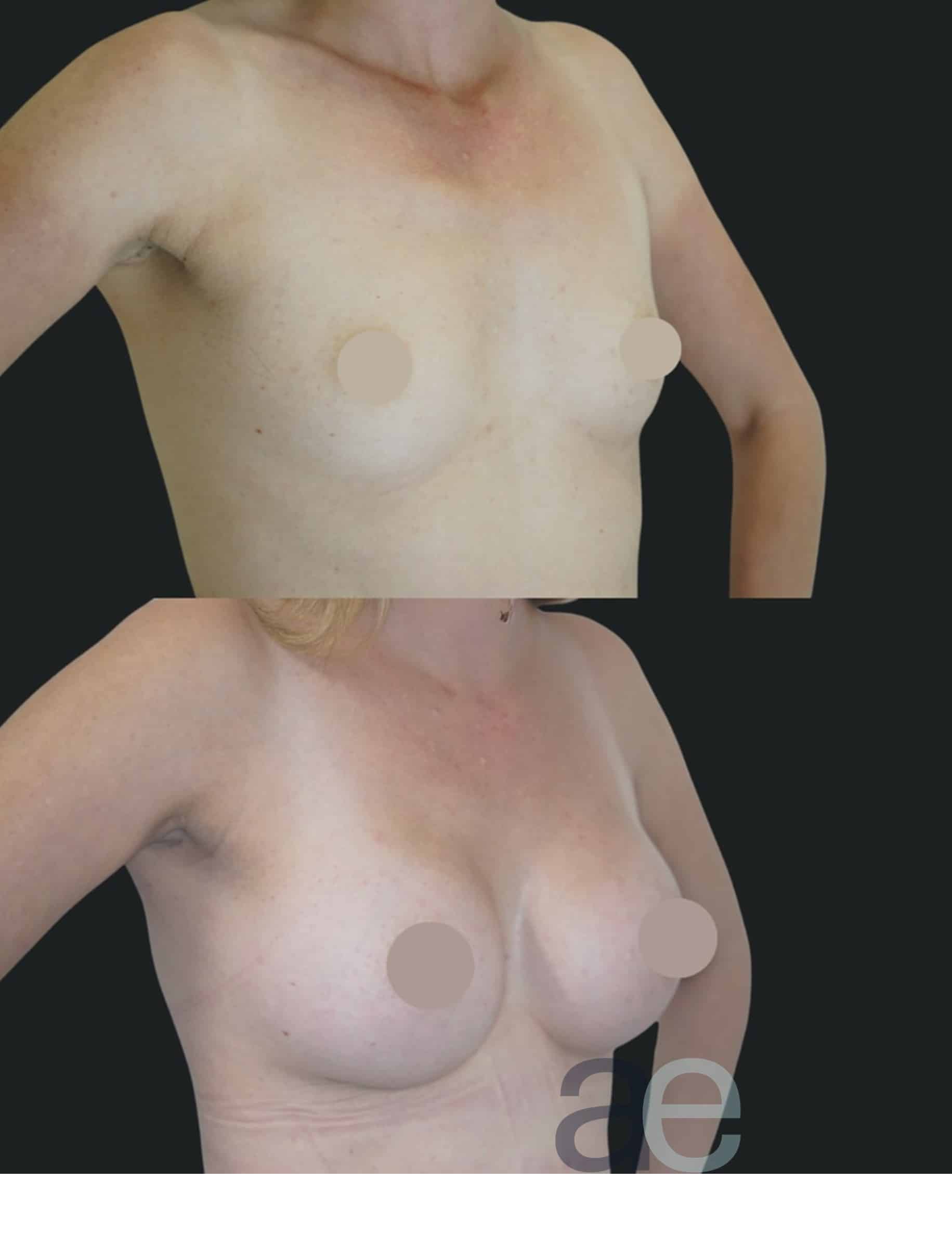 Breast implants before and after example at Aesthetica Image Centre, Armadale Melbourne