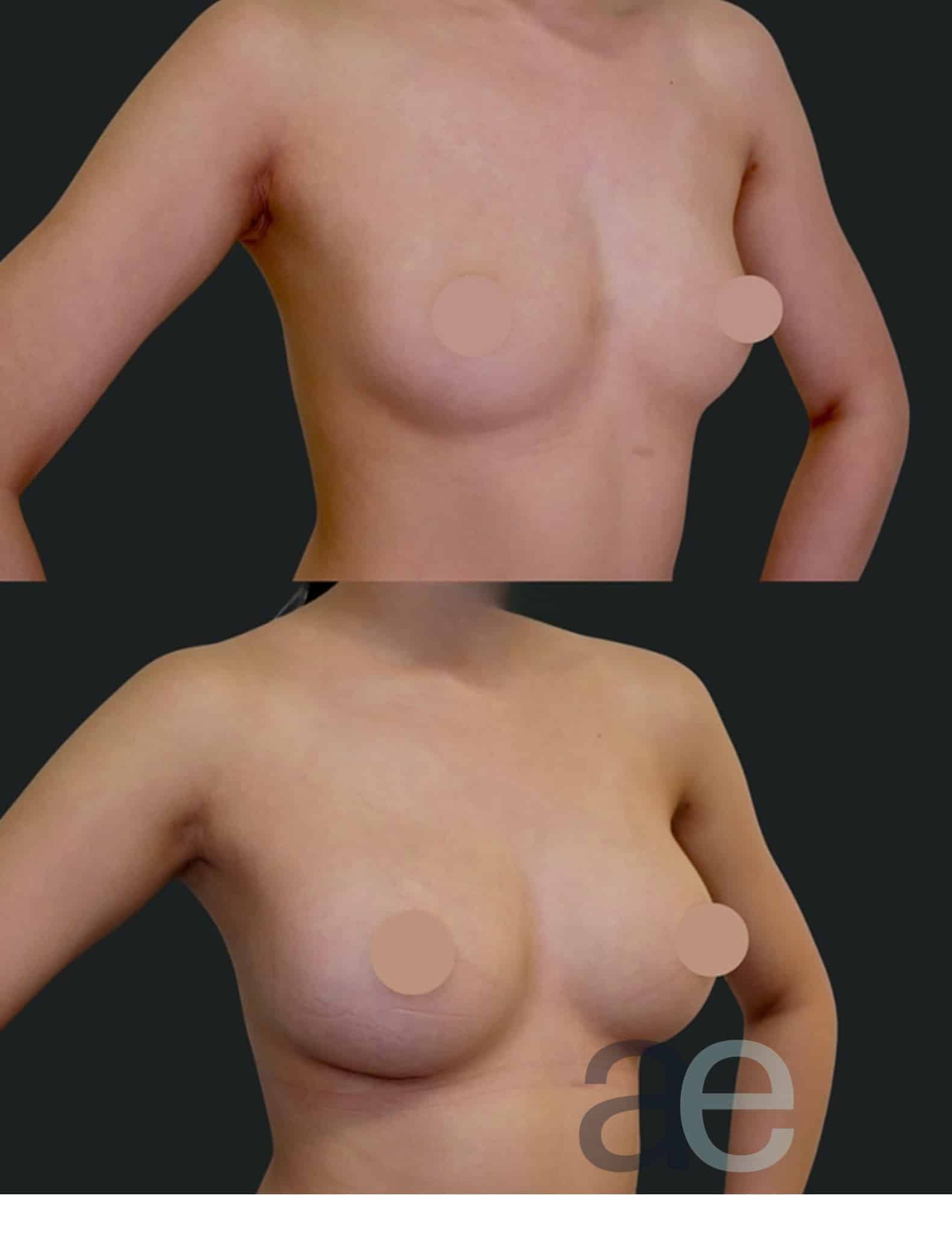 Breast implants before and after example at Aesthetica Image Centre, Armadale Melbourne